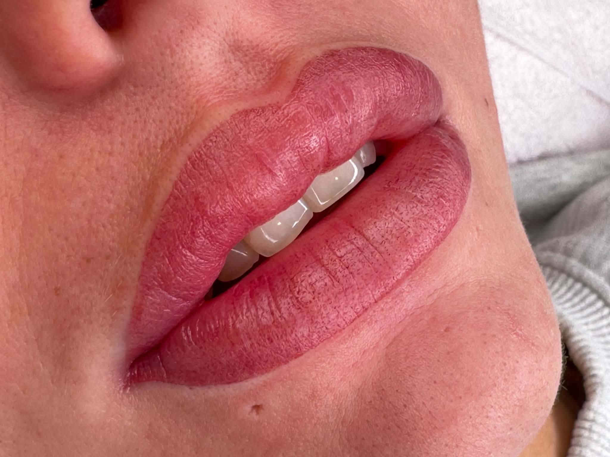 Permanent lepper rett etter behandling